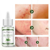 JoyPretty Tea Tree Acne Removal Serum with before and after images showing reduced acne marks and improved skin texture.