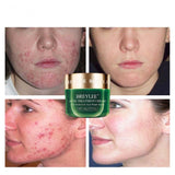 Before and after images showing the effects of Tea Tree Acne Cream on acne-prone skin, highlighting its moisturizing properties.