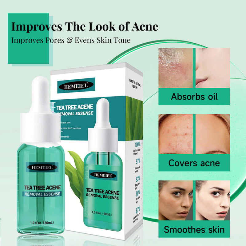 Tea Tree Acne Removal Liquid 30ml for oily skin, absorbs oil, improves pores and evens skin tone.