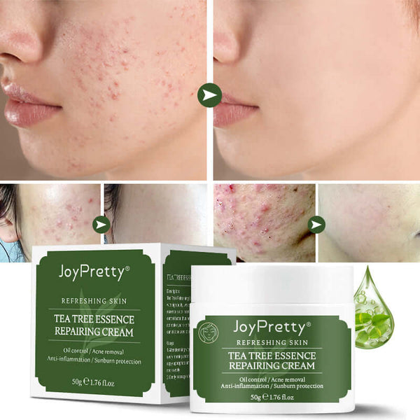Tea Tree Essence Repairing Cream by JoyPretty, shown with before and after acne treatment results, 50g packaging.