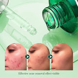 Tea Tree Hydrating Acne Control Oil with visible acne removal effects on skin, showing before and after results.