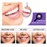 Before and after results of teeth whitening treatment showing improved smile and whiter teeth.