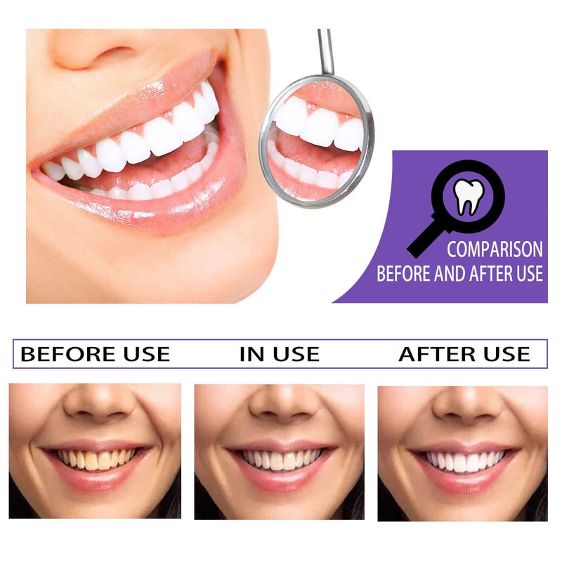 Before and after results of teeth whitening treatment showing improved smile and whiter teeth.